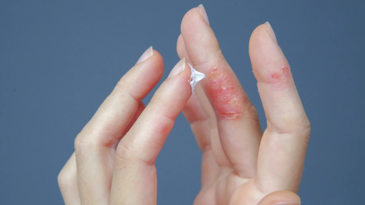 Blase am Finger was tun für eine schnelle Heilung