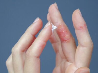 Blase am Finger was tun für eine schnelle Heilung