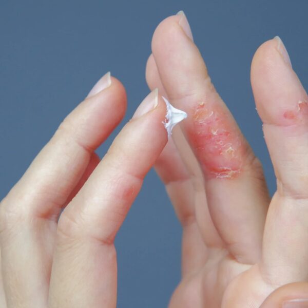Blase am Finger was tun für eine schnelle Heilung