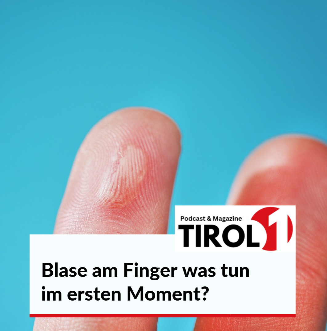 Blase am Finger was tun im ersten Moment Blase am Finger was tun im ersten Moment