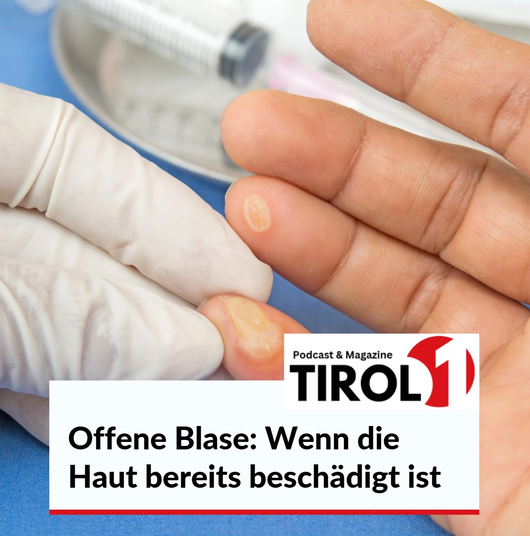 Offene Blase Wenn die Haut bereits beschädigt ist Offene Blase Wenn die Haut bereits beschädigt ist